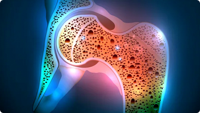 Yaşlıda Osteoporoz ve Diğer Kas İskelet Hastalıkları Grubu